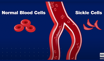 Sickle Cells in Blood