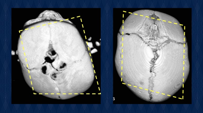 a heart xray