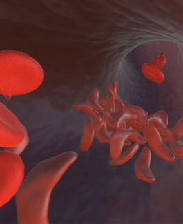 UC Consortium Launches First Clinical Trial Using CRISPR to Correct Gene Defect That Causes Sickle Cell Disease